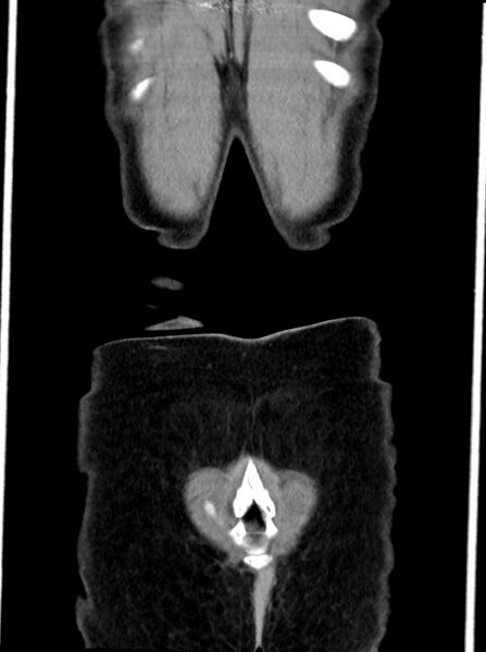 File:Abdominal wall and retroperitoneal tuberculosis (Radiopaedia 88137-104729 Coronal C+ portal venous phase 100).jpg