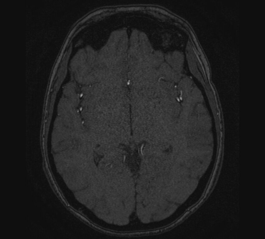 Accessory middle cerebral artery and ICA aneurysm (Radiopaedia 22656-22674 MRA 70).jpg