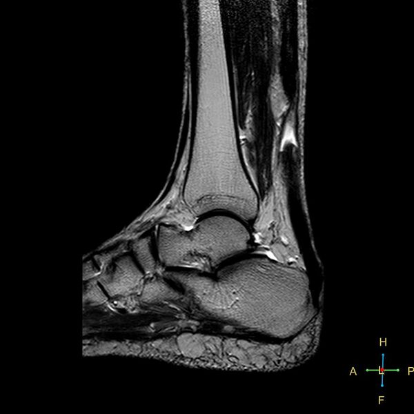 File:Achilles tendon complete tear (Radiopaedia 22834-22854 Sagittal T2 8).jpg