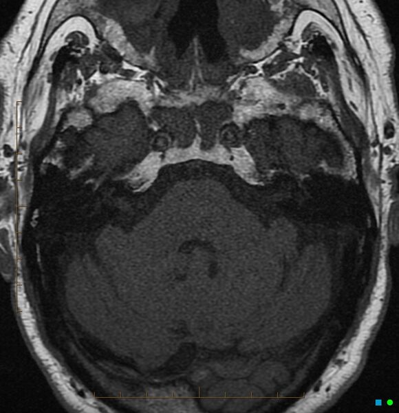 File:Acoustic schwannoma - intracanalicular (Radiopaedia 2675-6388 Axial T1 1).jpg