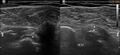 Acromioclavicular joint ganglion and long head of biceps brachii dislocation (Radiopaedia 12938-13043 B 1).jpg