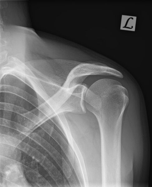 File:Acromioclavicular joint injury - Rockwood III (Radiopaedia 60196-67799 C 1).jpg