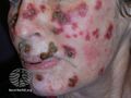 Actinic Keratoses treated with imiquimod (DermNet NZ lesions-ak-imiquimod-3723).jpg