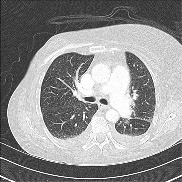 File:Acute-on-chronic pulmonary emboli (Radiopaedia 27925-28169 lung window 20).jpg