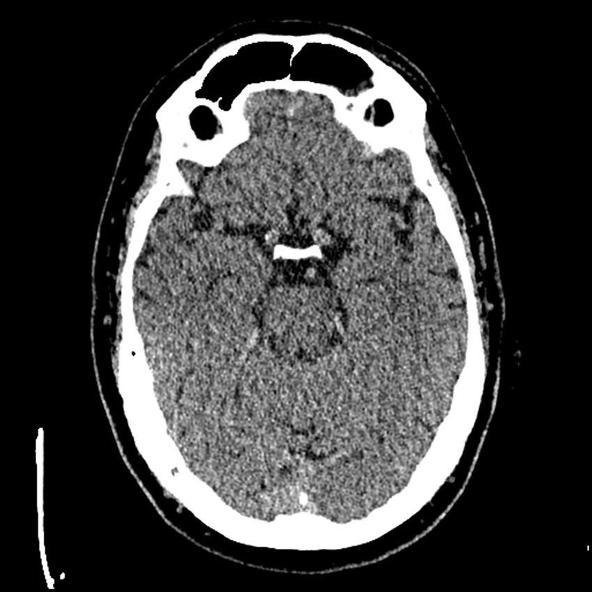 Acute A3 occlusion with ACA ischemic penumbra (CT perfusion) (Radiopaedia 72036-82525 Axial non-contrast thins 1).jpg