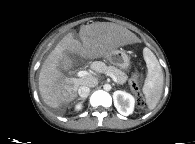File:Acute Budd-Chiari syndrome (Radiopaedia 60858-68638 Axial C+ portal venous phase 103).jpg
