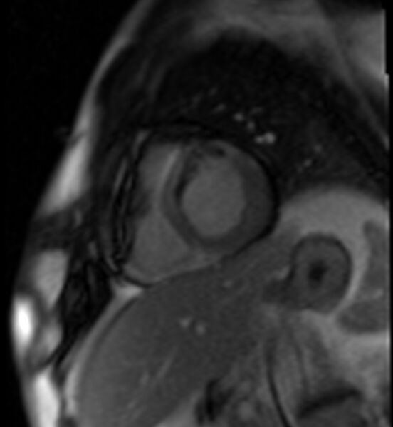 File:Acute anteroseptal myocardial infarction (Radiopaedia 68409-77945 Short axis (basal) Perfusion 48).jpg
