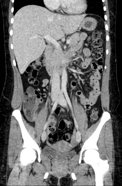 File:Acute appendicitis (Radiopaedia 22892-22918 Coronal C+ portal venous phase 23).png