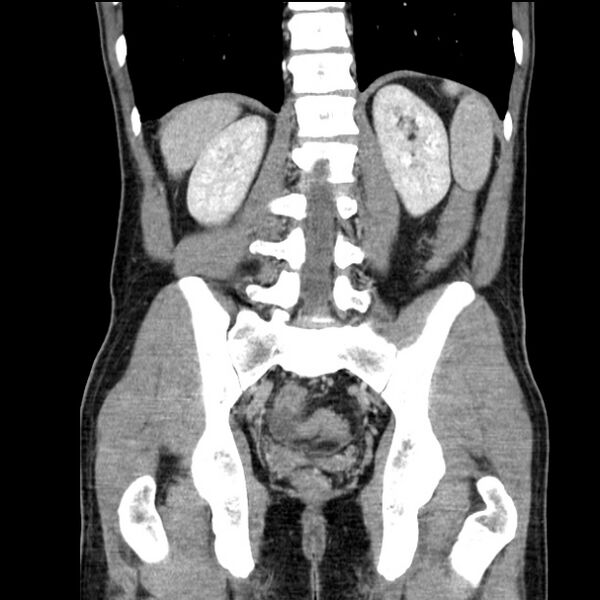 File:Acute appendicitis (Radiopaedia 27049-27227 Coronal C+ portal venous phase 41).jpg