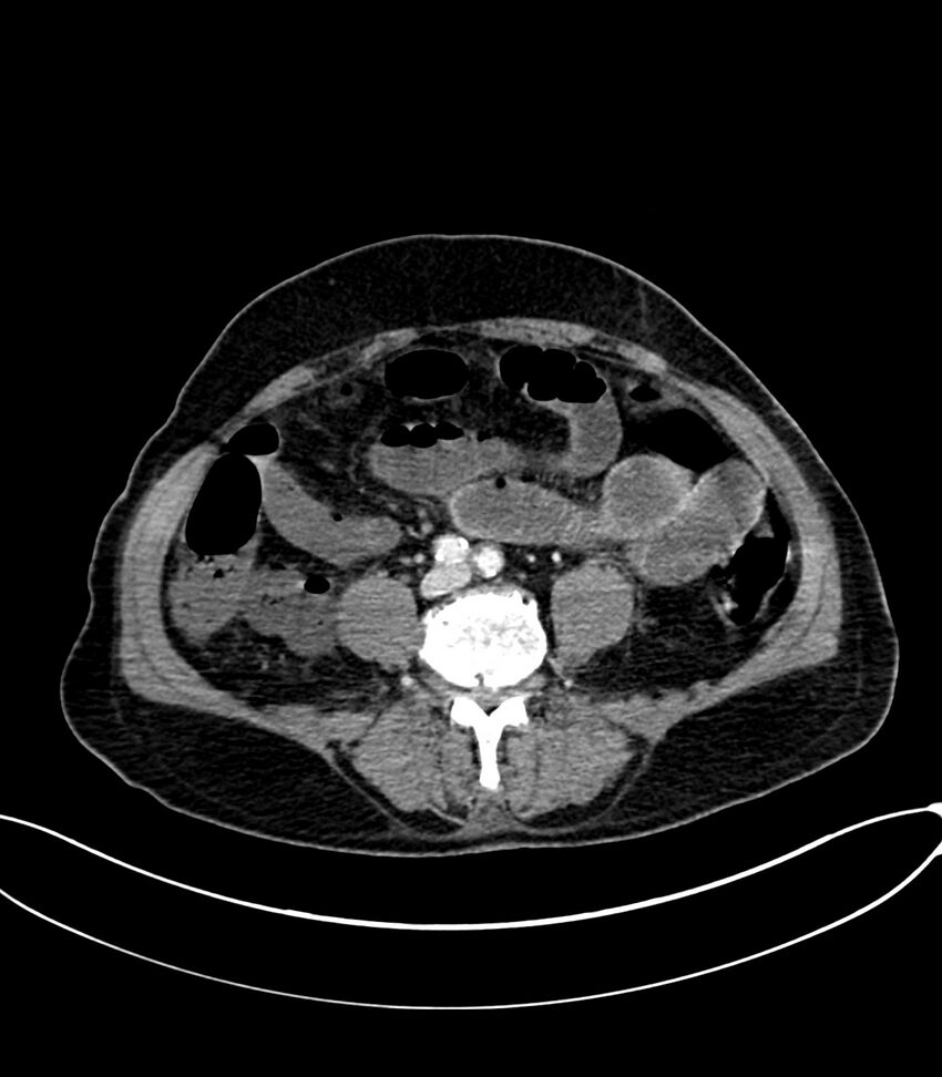 Acute arterial mesenteric ischemia (Radiopaedia 78238-90828 Axial C+ portal venous phase 87).jpg
