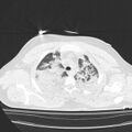 Acute aspiration pneumonitis (Radiopaedia 33605-34703 Axial lung window 25).jpg