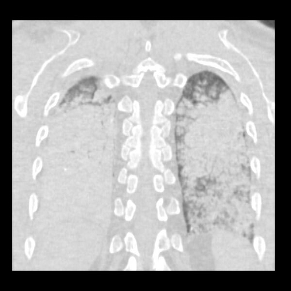 File:Acute diffuse alveolar hemorrhage (Radiopaedia 41323-44158 Coronal lung window 48).jpg
