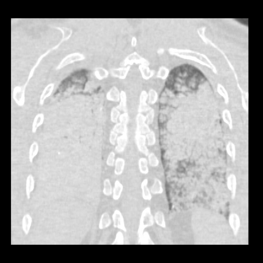 Acute diffuse alveolar hemorrhage (Radiopaedia 41323-44158 Coronal lung window 48).jpg