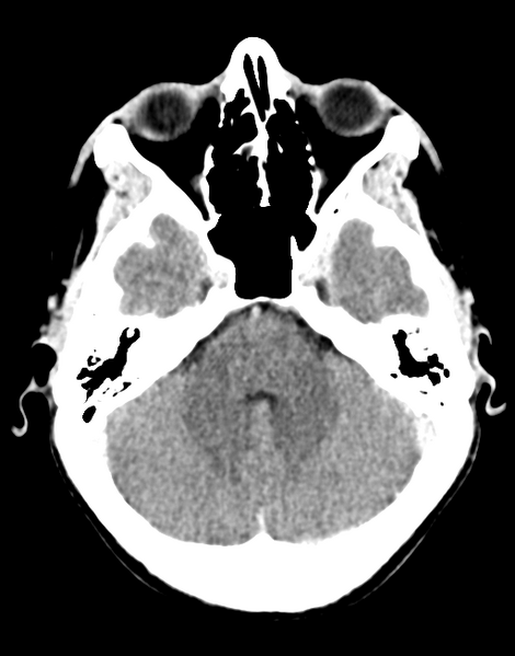 File:Acute disseminated encephalomyelitis (ADEM) (Radiopaedia 65319-74348 Axial C+ delayed 9).png