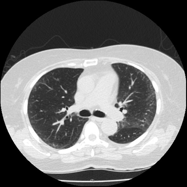 File:Acute interstitial pneumonitis (Radiopaedia 45404-49444 Axial lung window 45).jpg
