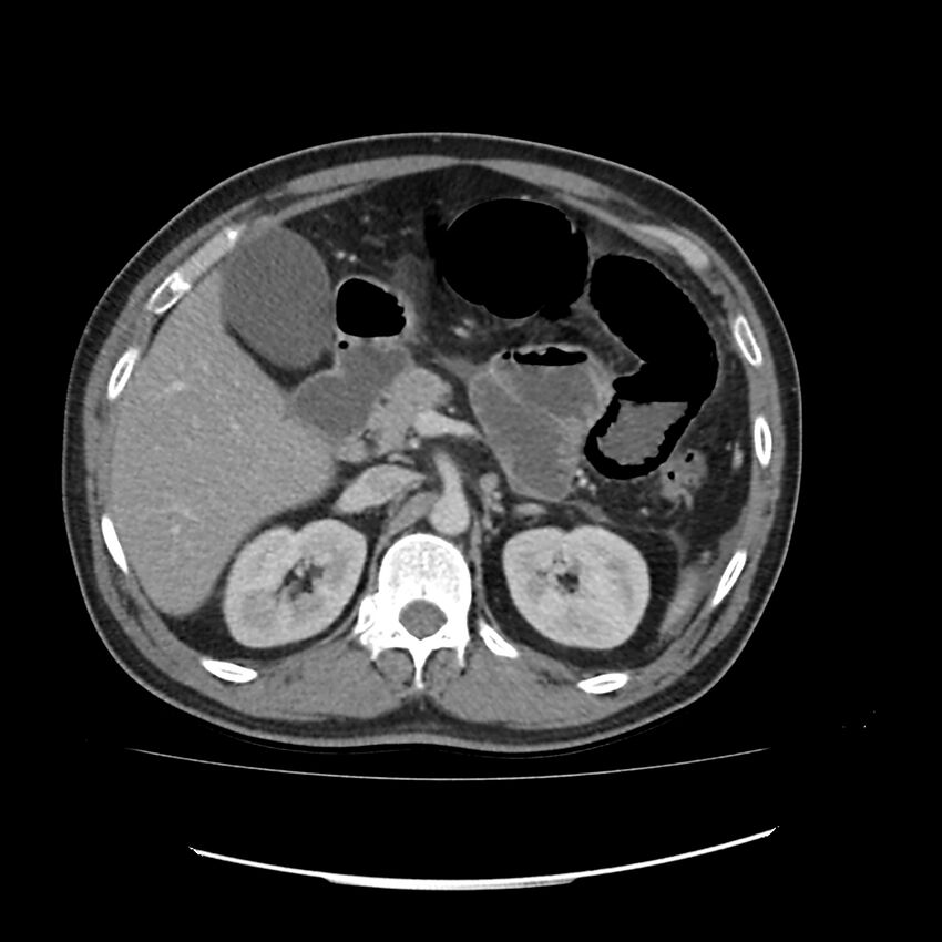 Acute mesenteric ischemia - superior mesenteric artery thrombosis (Radiopaedia 73947-84776 Axial C+ portal venous phase 29).jpg