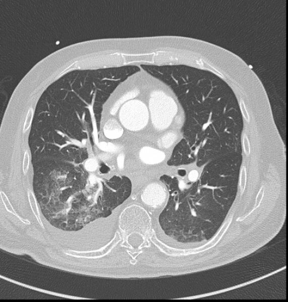File:Acute myocardial infarction (Radiopaedia 23413-23481 lung window 28).jpg