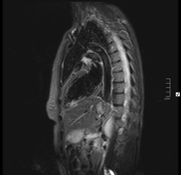 File:Acute myocarditis (Radiopaedia 40718-43366 Short axis T2 fat sat 9).PNG