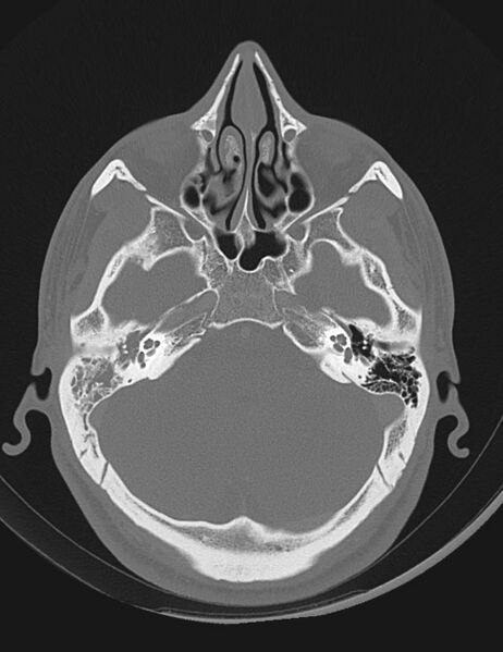 File:Acute otomastoiditis (Radiopaedia 28329-28575 Axial bone window 6).jpg