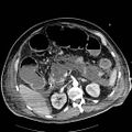 Acute pancreatic necrosis (Radiopaedia 13560-18502 Axial C+ portal venous phase 29).jpg