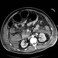 Acute pancreatic necrosis (Radiopaedia 13560-18502 Axial C+ portal venous phase 37).jpg