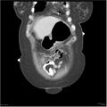 Acute pancreatitis (Radiopaedia 19136-19117 Coronal C+ portal venous phase 3).jpg