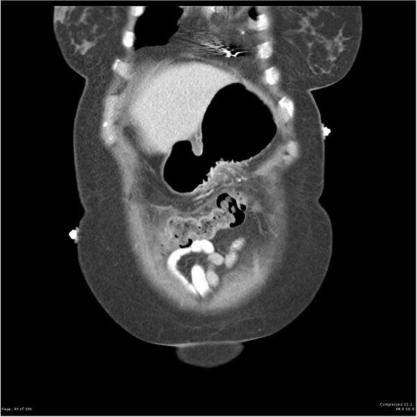 File:Acute pancreatitis (Radiopaedia 19136-19117 Coronal C+ portal venous phase 3).jpg