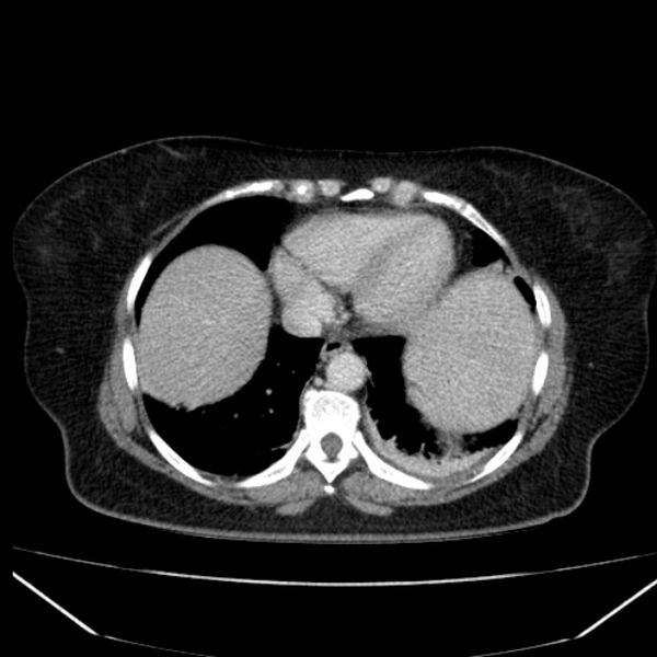 File:Acute pancreatitis - Balthazar C (Radiopaedia 26569-26714 Axial C+ portal venous phase 17).jpg
