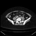 Acute pancreatitis - Balthazar C (Radiopaedia 26569-26714 Axial C+ portal venous phase 68).jpg