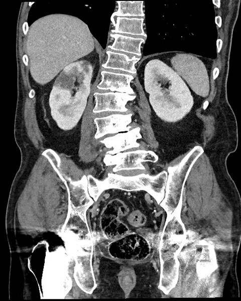 File:Acute renal infarction - rim capsular enhancement (Radiopaedia 59833-67270 Coronal C+ portal venous phase 43).jpg