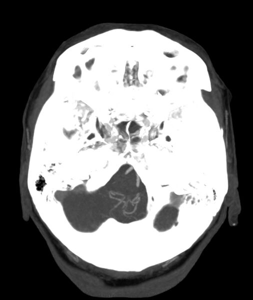 File:Acute right MCA M1 occlusion (Radiopaedia 62268-70454 Axial Phase 1 24).jpg