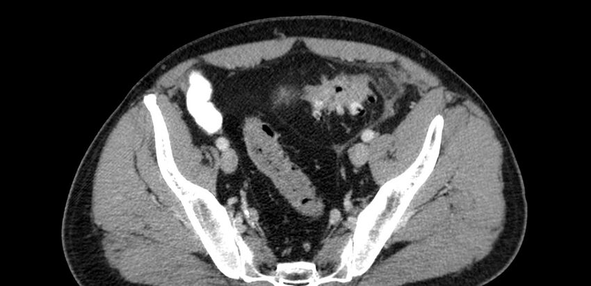 Acute sigmoid colon diverticulitis (Radiopaedia 55507-61976 Axial C+ portal venous phase 89).jpg