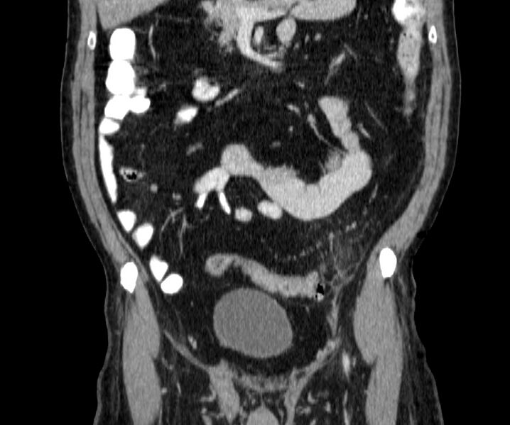 File:Acute sigmoid colon diverticulitis (Radiopaedia 55507-61976 Coronal C+ portal venous phase 53).jpg