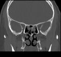 Acute sinusitis (Radiopaedia 23161-23215 Coronal bone window 44).jpg