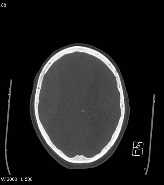 File:Acute subdural hematoma with myelofibrosis (Radiopaedia 52582-58494 Axial bone window 44).jpg