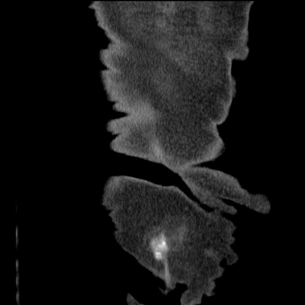 File:Acute tubular necrosis (Radiopaedia 28077-28334 D 81).jpg