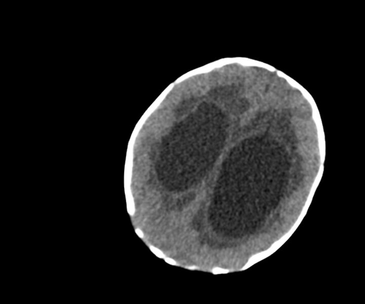 File:Acute ventriculitis (Radiopaedia 57502-64459 Axial non-contrast 14).jpg