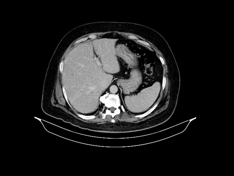 File:Adenocarcinoma of pancreas with hepatic metastasis (Radiopaedia 64332-73122 Axial C+ delayed 23).jpg