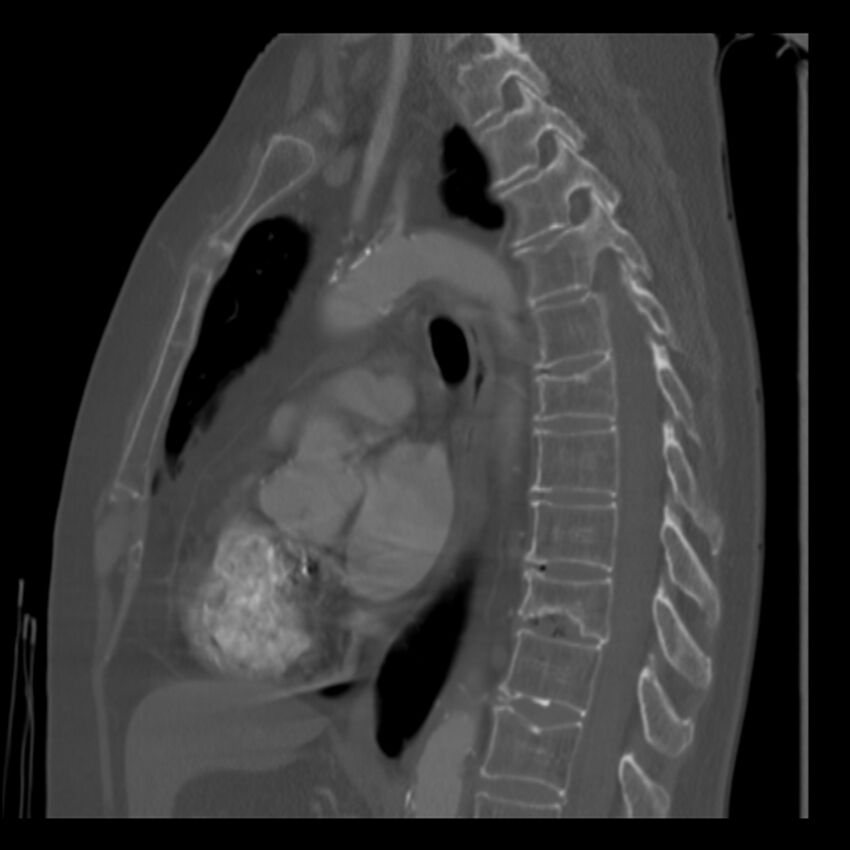 Adenocarcinoma of the lung (Radiopaedia 41015-43755 Sagittal bone window 56).jpg