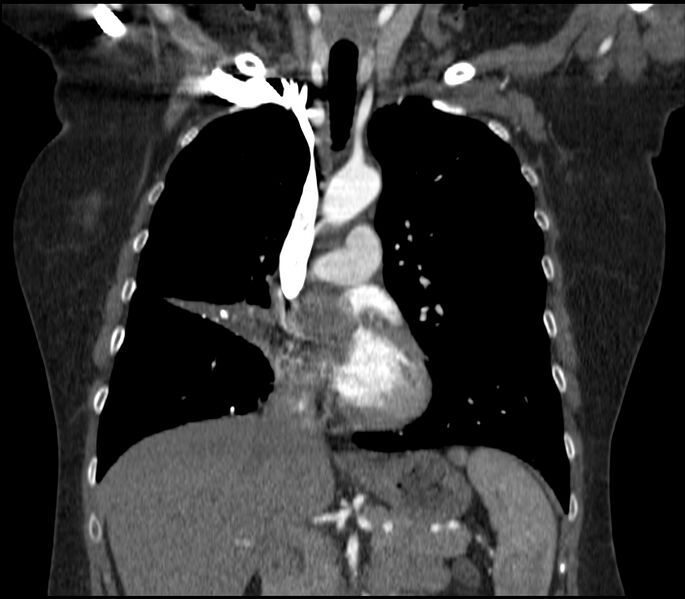 File:Adenocarcinoma of the lung (Radiopaedia 44205-47803 Coronal C+ portal venous phase 38).jpg