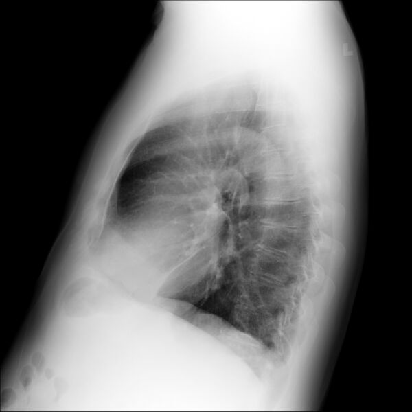 File:Adenocarcinoma of the lung (Radiopaedia 44876-48757 Lateral 1).jpg