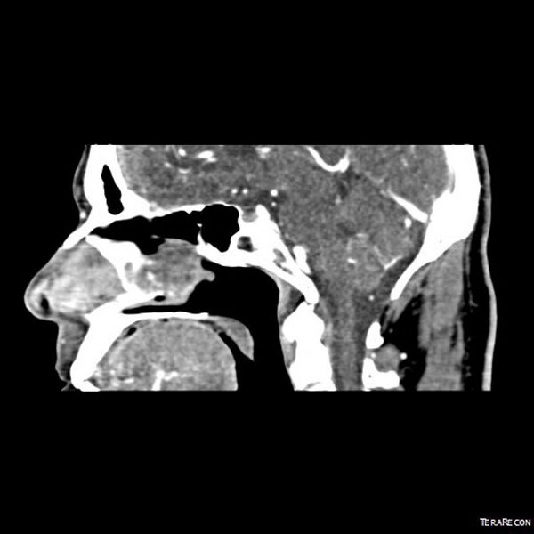File:Adenoid cystic carcinoma involving paranasal sinus (Radiopaedia 16580-16283 Sagittal C+ arterial phase 3).jpeg