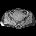 Adenomyoma of the uterus (huge) (Radiopaedia 9870-10438 Axial T1 fat sat 17).jpg