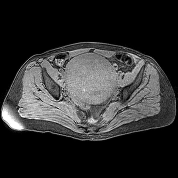 File:Adenomyoma of the uterus (huge) (Radiopaedia 9870-10438 Axial T1 fat sat 17).jpg