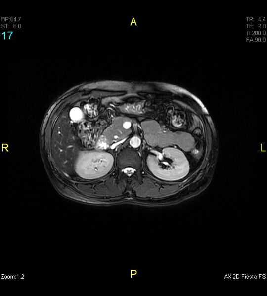File:Adenomyosis (Radiopaedia 43504-46889 Axial 2D FIESTA 17).jpg