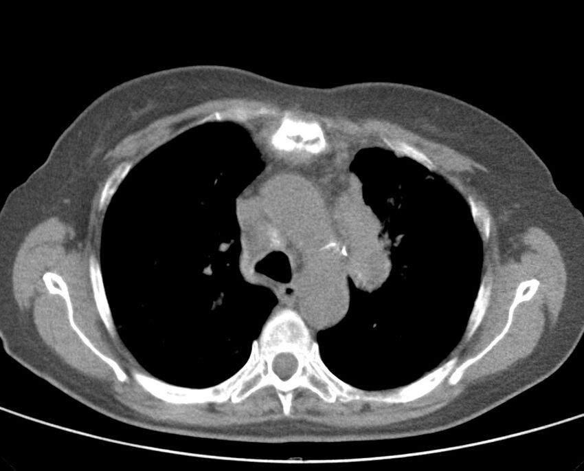 Adenosquamous lung carcinoma (Radiopaedia 22035-22030 non-contrast 25).jpg