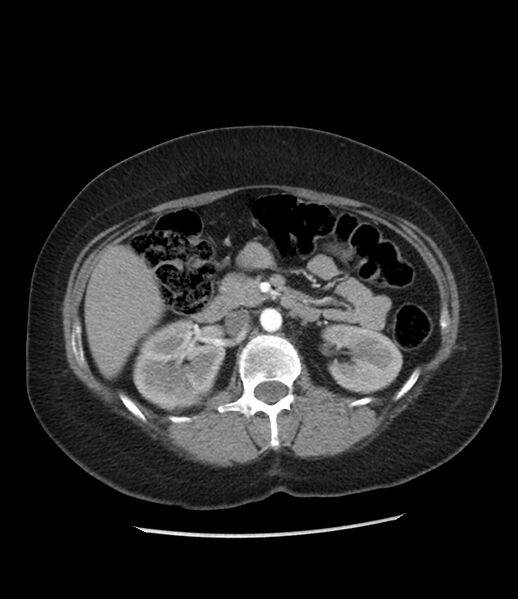 File:Adrenal cortical carcinoma with IVC invasion and thrombosis (Radiopaedia 34307-35597 Axial C+ arterial phase 36).jpg