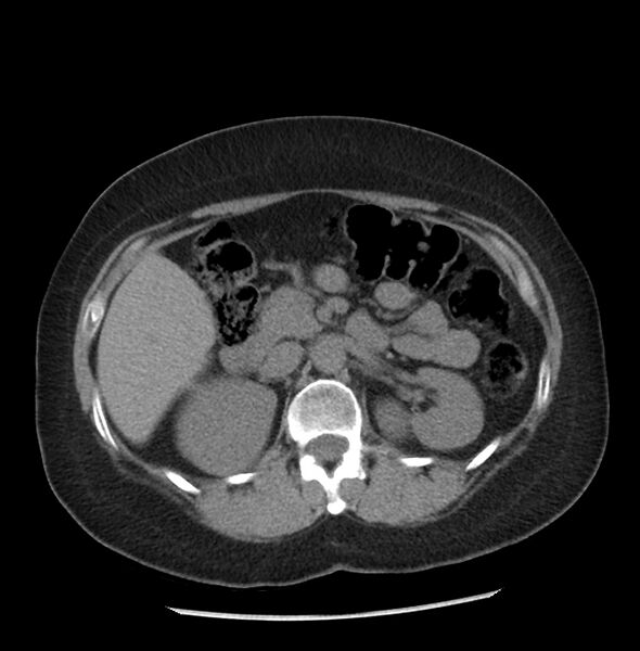File:Adrenal cortical carcinoma with IVC invasion and thrombosis (Radiopaedia 34307-35597 Axial non-contrast 21).jpg