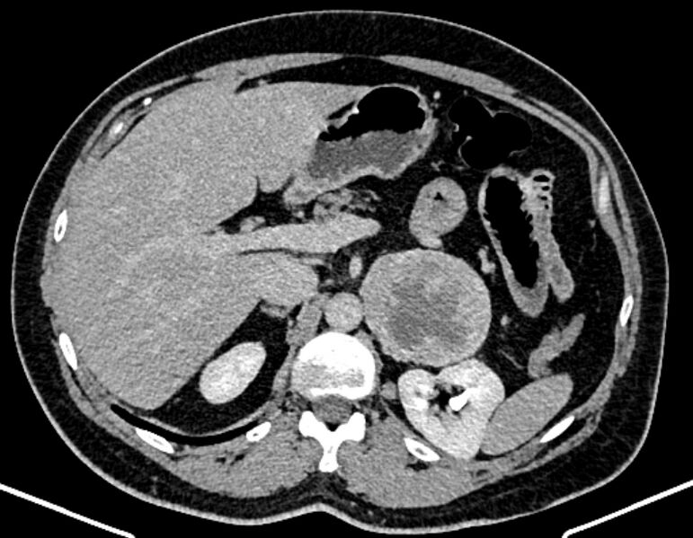 File:Adrenal metastases (Radiopaedia 73082-83791 Axial C+ delayed 99).jpg