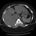 Adrenal myelolipoma (Radiopaedia 8216-9068 Axial non-contrast 2).jpg